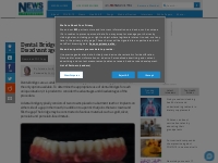   	Dental Bridges - Advantages and Disadvantages